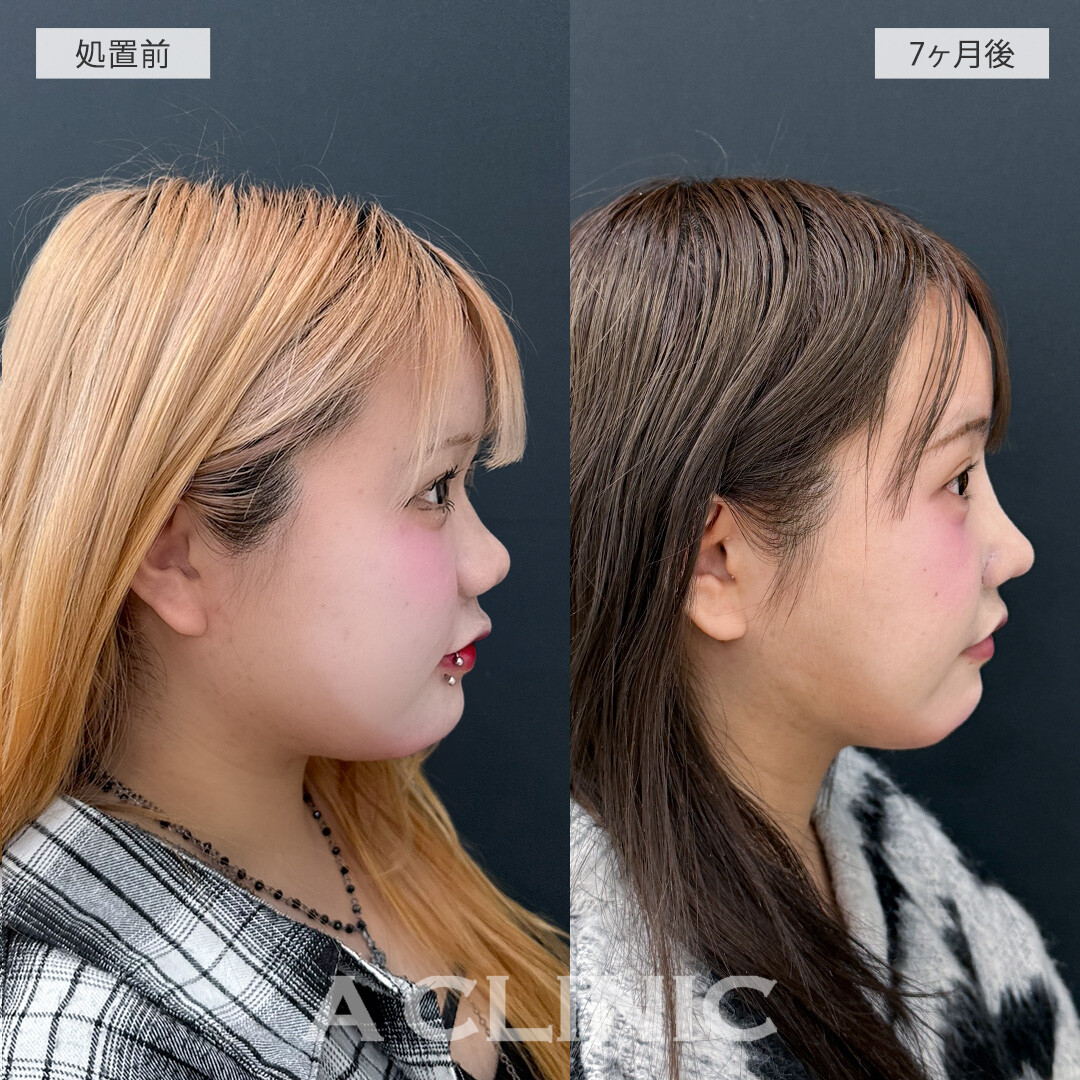1day小顔脂肪吸引で別人級の小顔に大変身！処置前と7ヶ月後の症例です(10代女性)