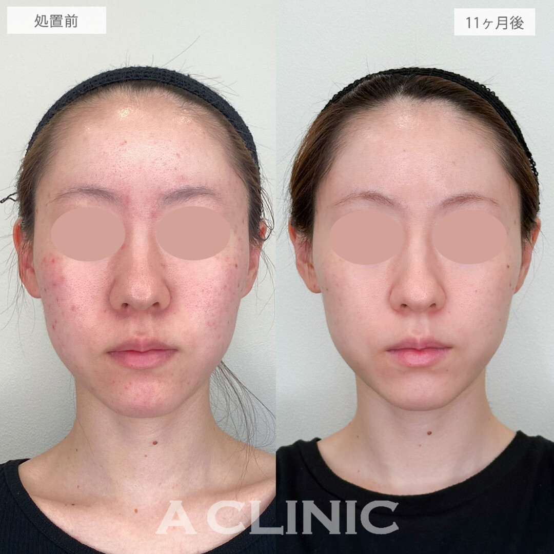 イソトレチノインとポテンツァとエレクトロポレーションでニキビの根本治療と再発防止が同時に叶う！処置前と11ヶ月後の症例です(20代女性)