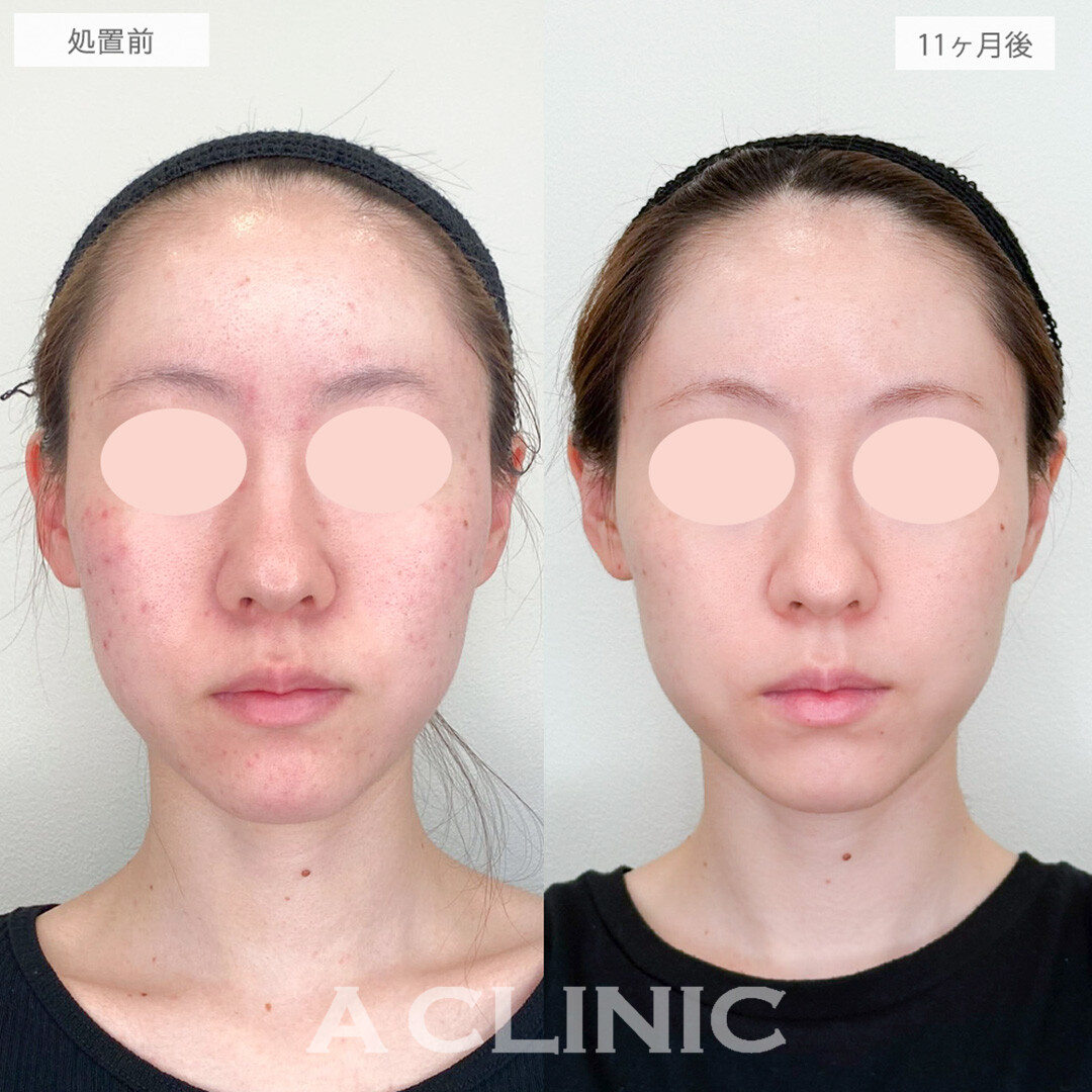 イソトレチノインとポテンツァとエレクトロポレーションでニキビの根本治療と再発防止が同時に叶う！処置前と11ヶ月後の症例です(20代女性)