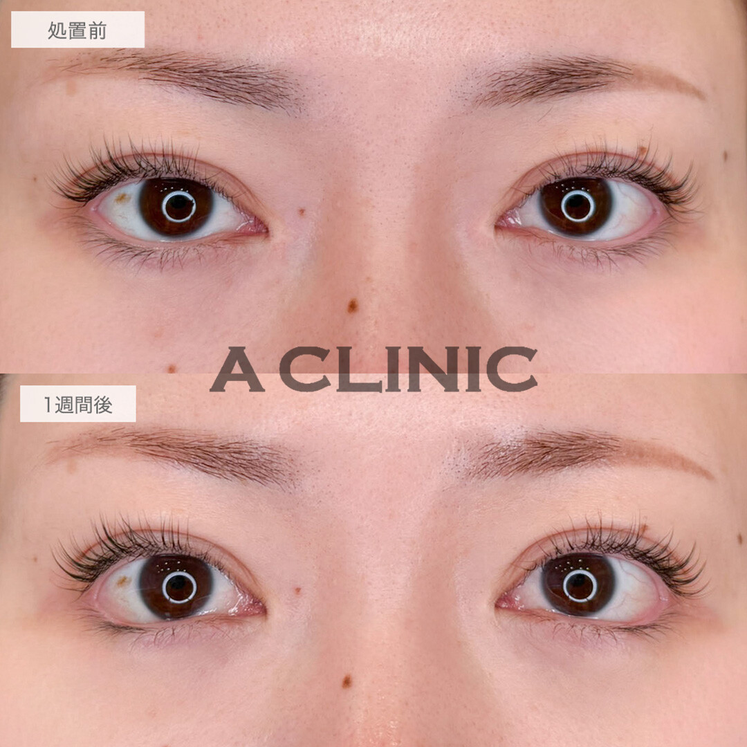 パーフェクトアイズでつり目と左右差が改善され優しい印象のお目元に！処置前と1週間後の症例です(40代女性)