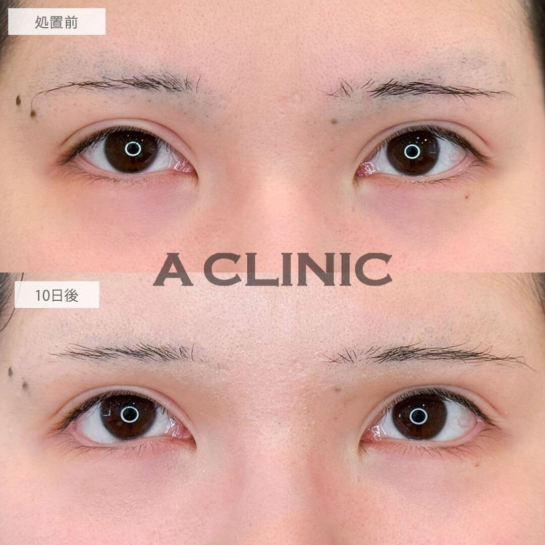 パーフェクトアイズとたれ目ボトックス注射で左右差が改善され憧れのたれ目が手に入りました！処置前と10日後の症例です(20代女性)