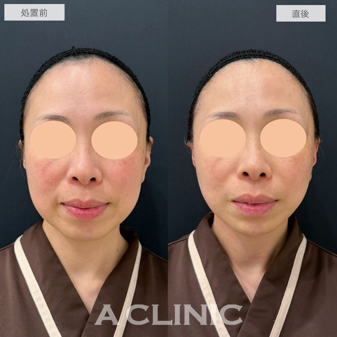 A式美肌たるみ切開とあごへのヒアルロン酸注入でたるみがぐっと引きあがり直後から若返りが可能に！処置前と直後の症例です(40代女性)