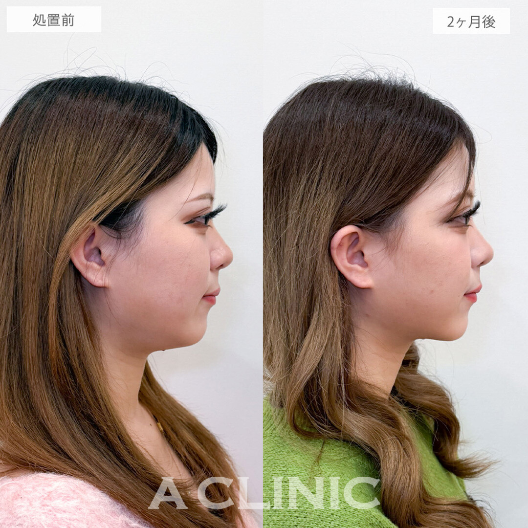 1day小顔脂肪吸引と小顔エラボトックスで首との境目がクッキリシャープになりました！処置前と2ヶ月後の症例です(20代女性)