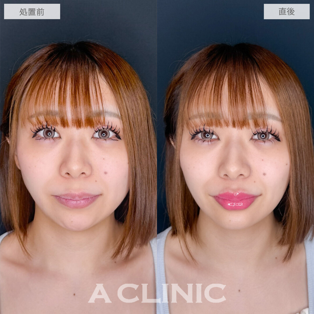 涙袋形成術(ヒアルロン酸)とリップヒアルロン酸注入で簡単に中顔面短縮が叶います！こちら処置前と直後の症例です(20代女性)