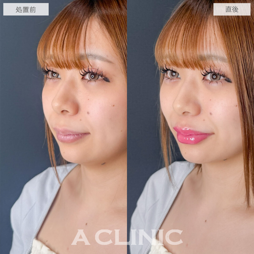 涙袋形成術(ヒアルロン酸)とリップヒアルロン酸注入で簡単に中顔面短縮が叶います！こちら処置前と直後の症例です(20代女性)
