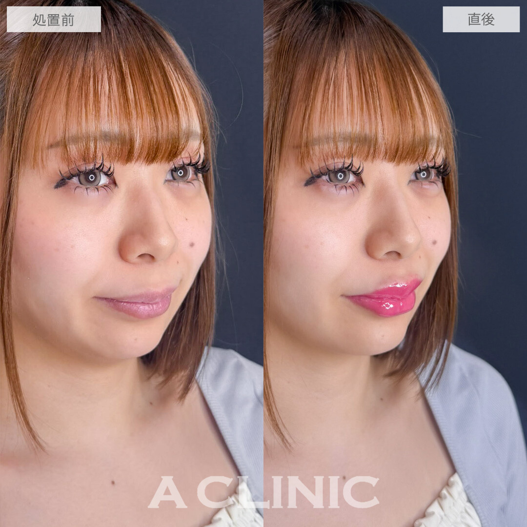 涙袋形成術(ヒアルロン酸)とリップヒアルロン酸注入で簡単に中顔面短縮が叶います！こちら処置前と直後の症例です(20代女性)