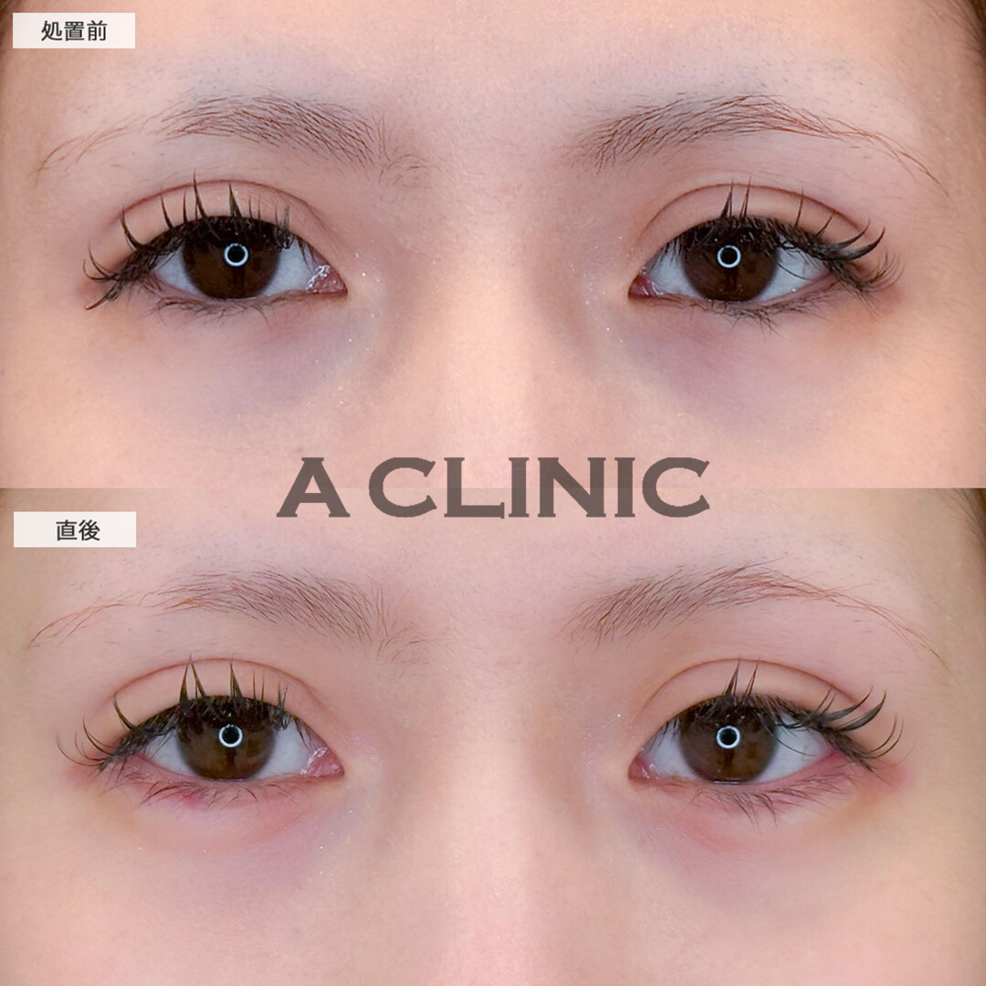 涙袋形成術(ヒアルロン酸)でぷっくり涙袋メイクいらずの目元に！こちら処置前と直後の症例です(20代女性)