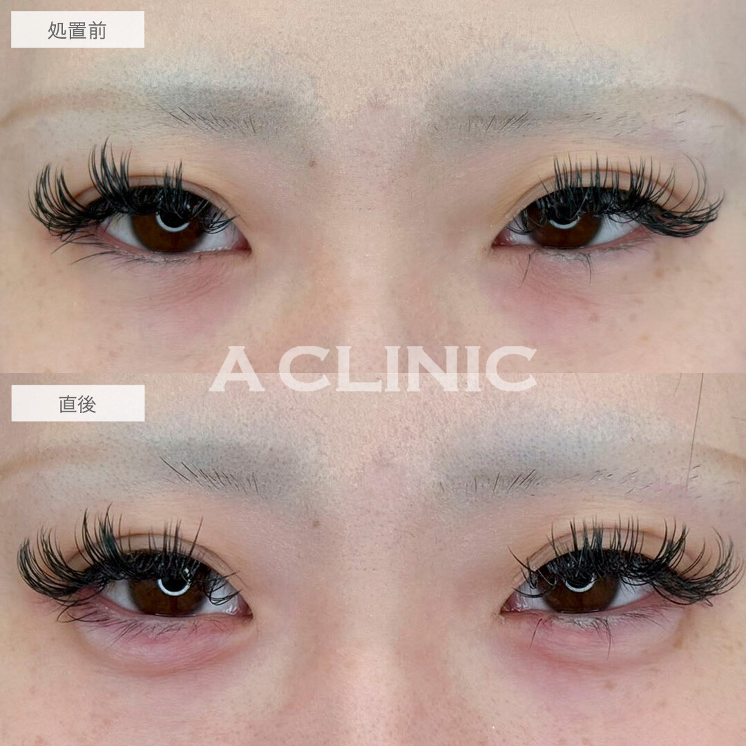 涙袋形成術(ヒアルロン酸)ですっぴんでも目力アップ！処置前と直後の症例です(20代女性)