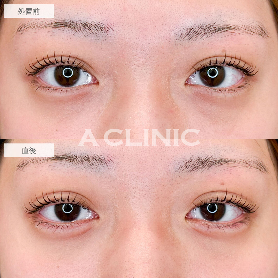 涙袋形成術(ヒアルロン酸)でぷっくり愛され涙袋へ変化！こちら処置前と直後の症例です(20代女性)