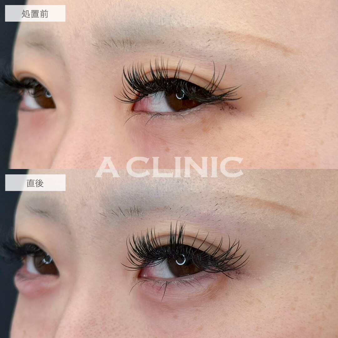 涙袋形成術(ヒアルロン酸)ですっぴんでも目力アップ！処置前と直後の症例です(20代女性)