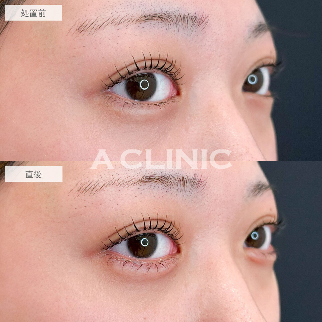 涙袋形成術(ヒアルロン酸)でぷっくり愛され涙袋へ変化！こちら処置前と直後の症例です(20代女性)