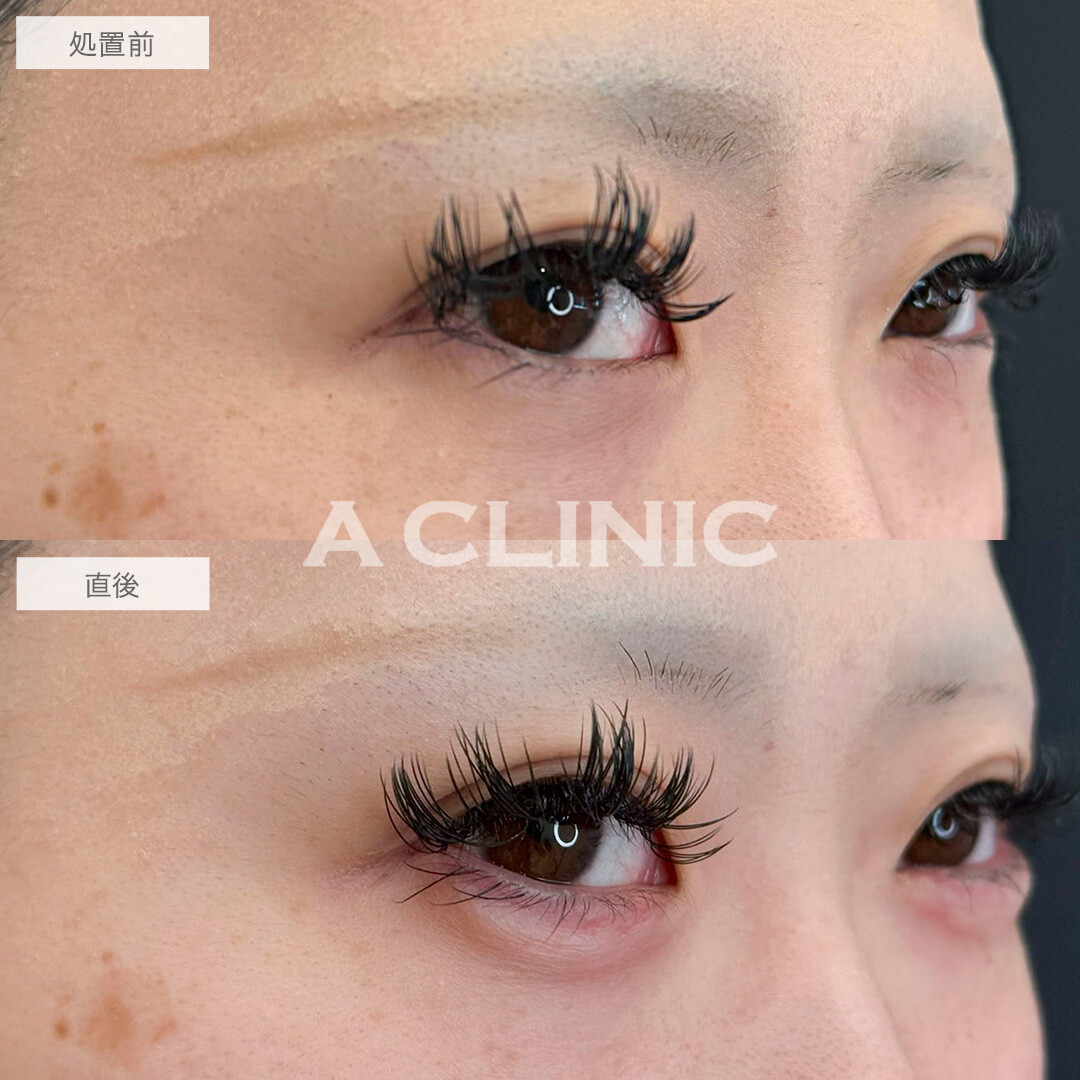 涙袋形成術(ヒアルロン酸)ですっぴんでも目力アップ！処置前と直後の症例です(20代女性)