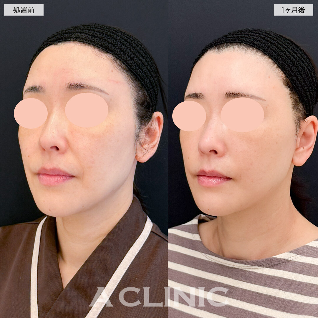 A式ナゾラリフトと耳下リフトでほうれい線が薄くなり実年齢よりも若く見られるようになりました！処置前と1ヶ月後の症例です(50代女性)