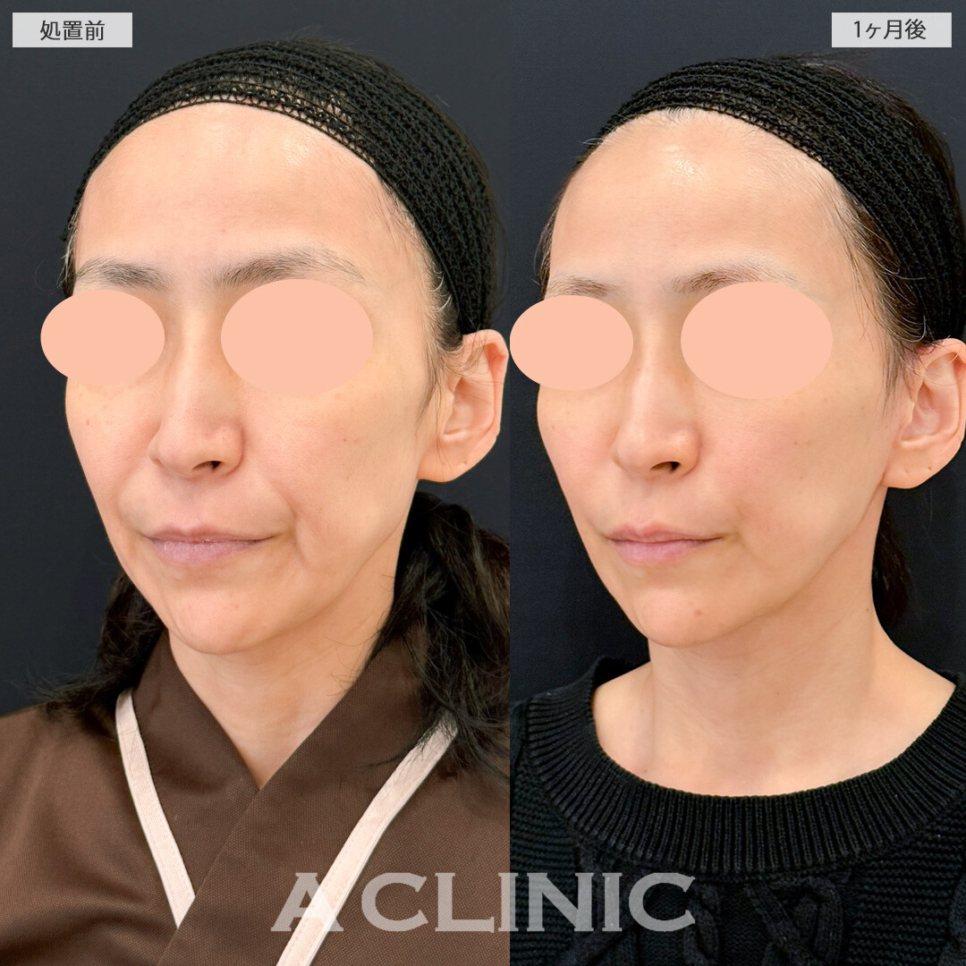 【直後の傷跡あり】A式ナゾラリフトでほうれい線による老け顔を解消できました！処置前と1ヶ月後の症例です(40代女性)