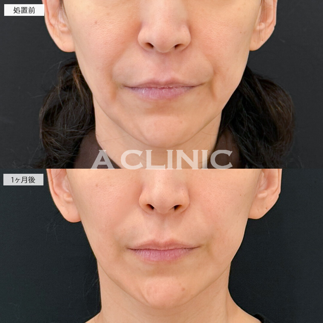 【直後の傷跡あり】A式ナゾラリフトでほうれい線による老け顔を解消できました！処置前と1ヶ月後の症例です(40代女性)