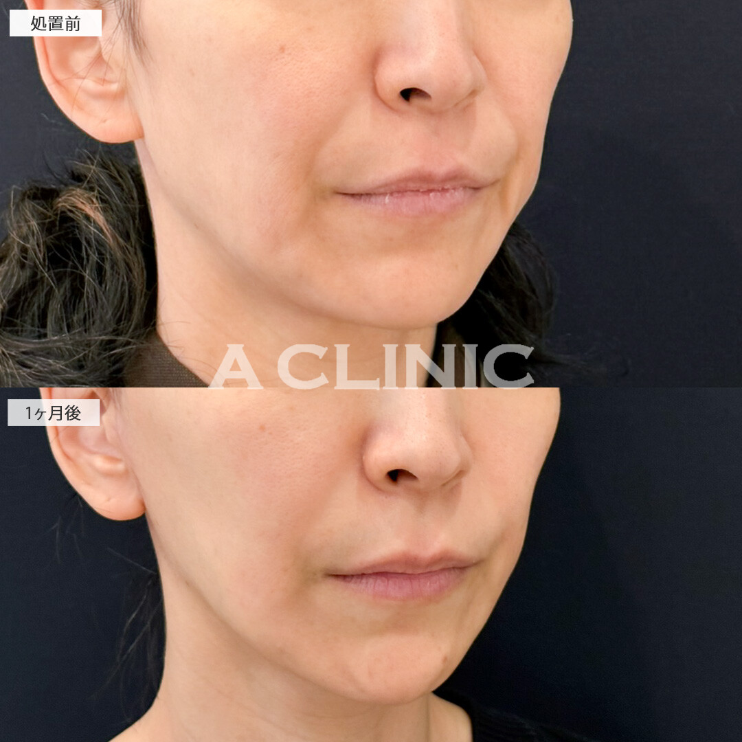 【直後の傷跡あり】A式ナゾラリフトでほうれい線による老け顔を解消できました！処置前と1ヶ月後の症例です(40代女性)