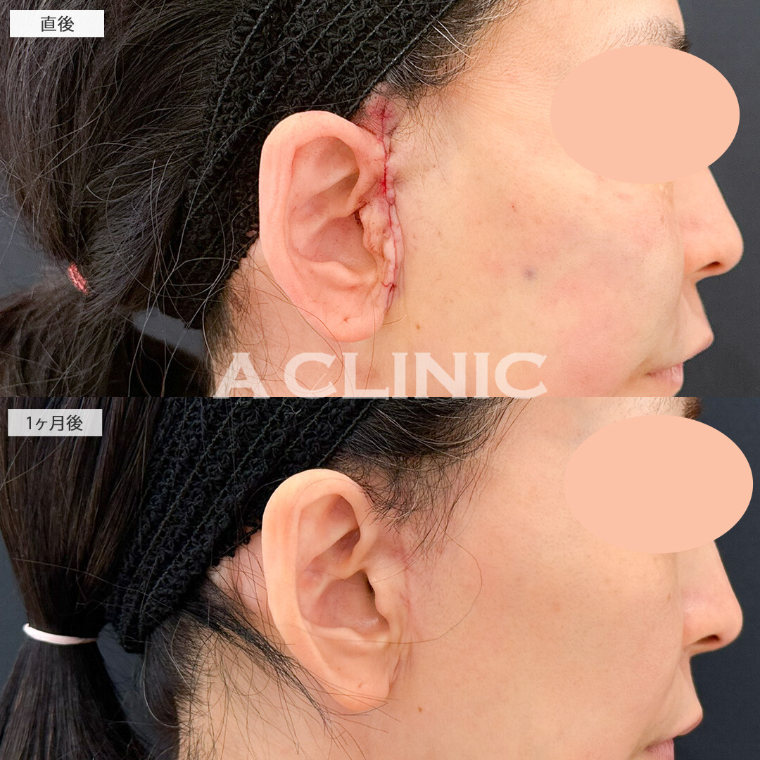 【直後の傷跡あり】A式ナゾラリフトでほうれい線による老け顔を解消できました！処置前と1ヶ月後の症例です(40代女性)