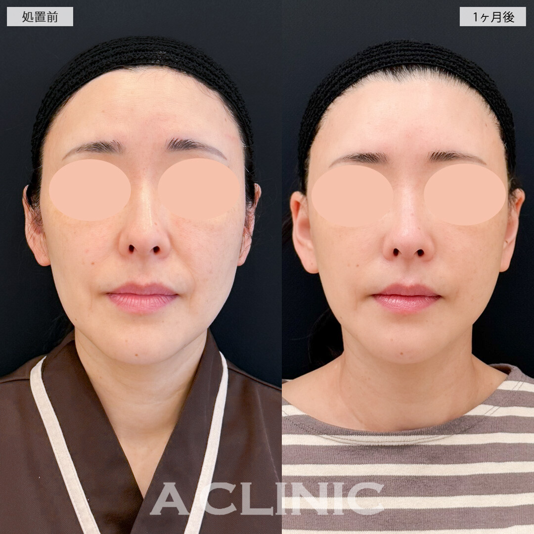 A式ナゾラリフトと耳下リフトでほうれい線が薄くなり実年齢よりも若く見られるようになりました！処置前と1ヶ月後の症例です(50代女性)