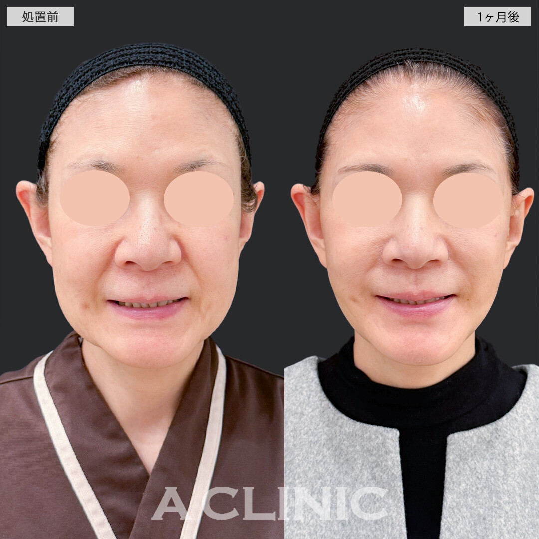 A式ナゾラリフトとバッカルファット除去術で脂肪と皮膚のたるみを同時に解消し若返り効果抜群！処置前と1ヶ月後の症例です(60代女性)