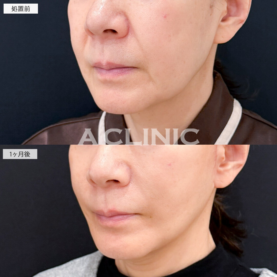 A式ナゾラリフトとバッカルファット除去術で脂肪と皮膚のたるみを同時に解消し若返り効果抜群！処置前と1ヶ月後の症例です(60代女性)