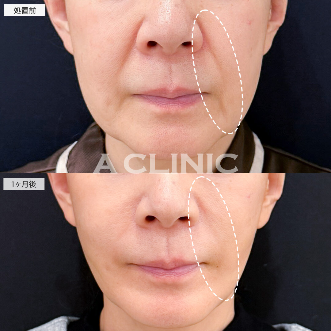 A式ナゾラリフトとバッカルファット除去術で脂肪と皮膚のたるみを同時に解消し若返り効果抜群！処置前と1ヶ月後の症例です(60代女性)