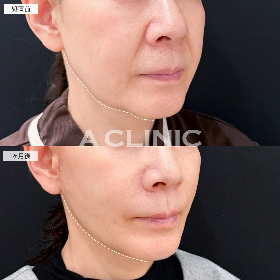 A式ナゾラリフトとバッカルファット除去術で脂肪と皮膚のたるみを同時に解消し若返り効果抜群！処置前と1ヶ月後の症例です(60代女性)
