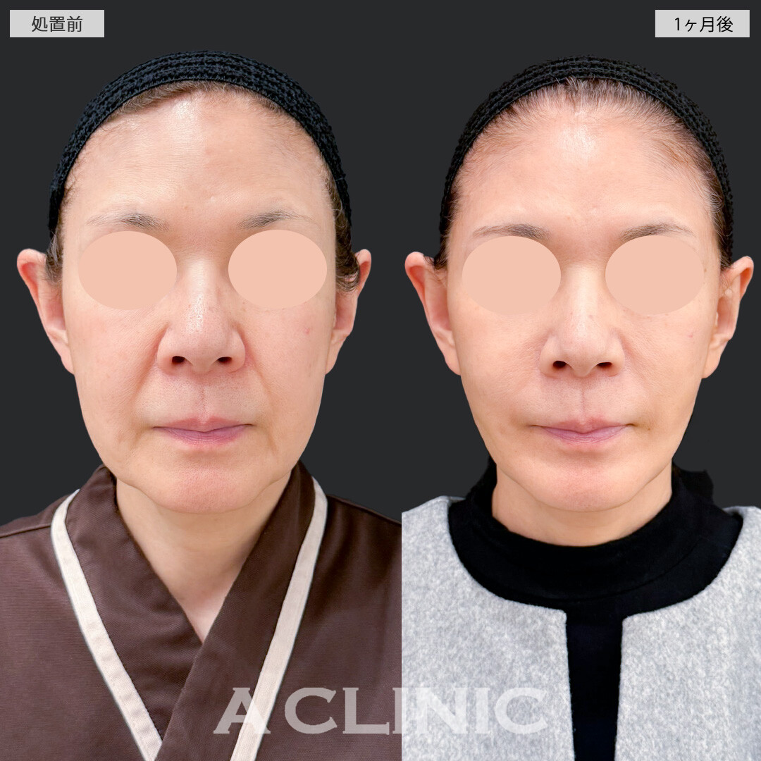 A式ナゾラリフトとバッカルファット除去術で脂肪と皮膚のたるみを同時に解消し若返り効果抜群！処置前と1ヶ月後の症例です(60代女性)