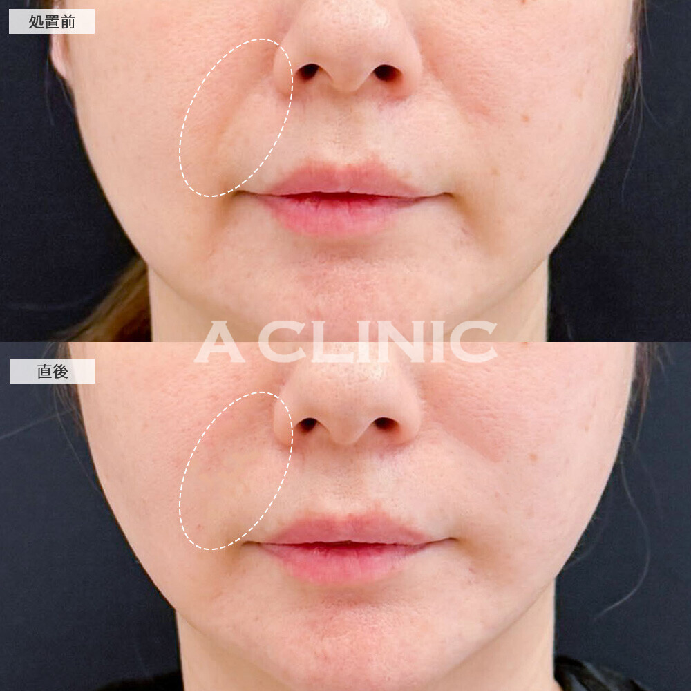 ヒアルロン酸注射(シワ)でほうれい線が目立たなくなりました！処置前と直後の症例です(40代女性)