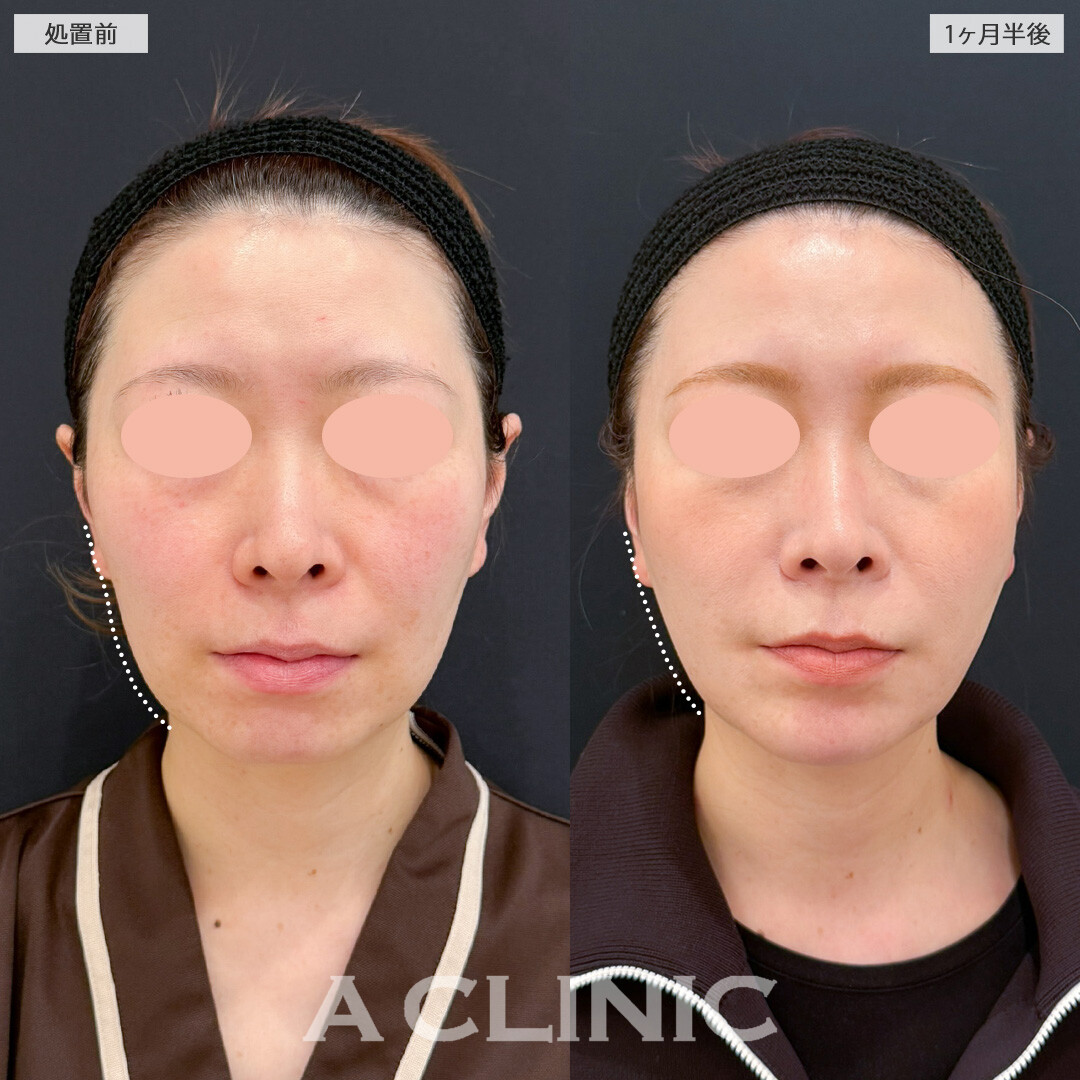 1day小顔脂肪吸引で要らない脂肪がなくなりアゴ下もかなりすっきりしました！こちら処置前と1ヶ月半後の症例です(40代女性)