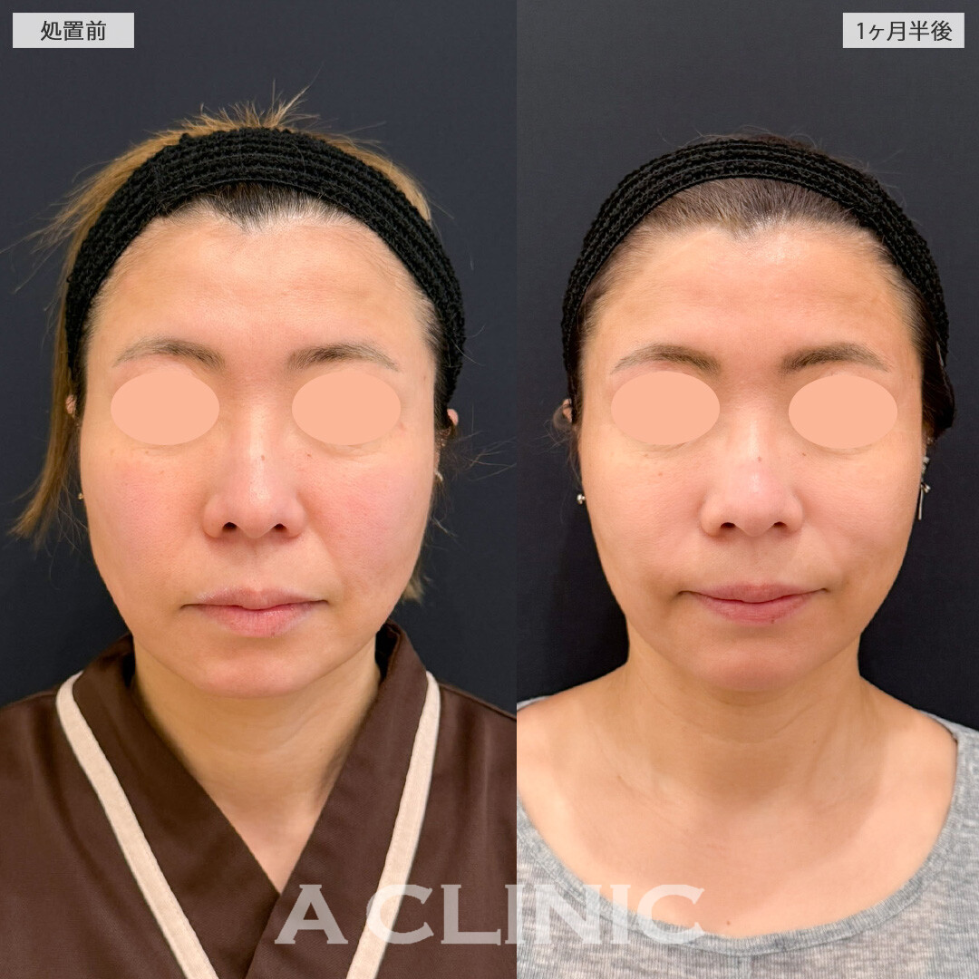 A式ナゾラリフトとバッカルファット除去術で笑った時のボリューム感を抑えられます！こちら処置前と1ヶ月半後の症例です(40代女性)