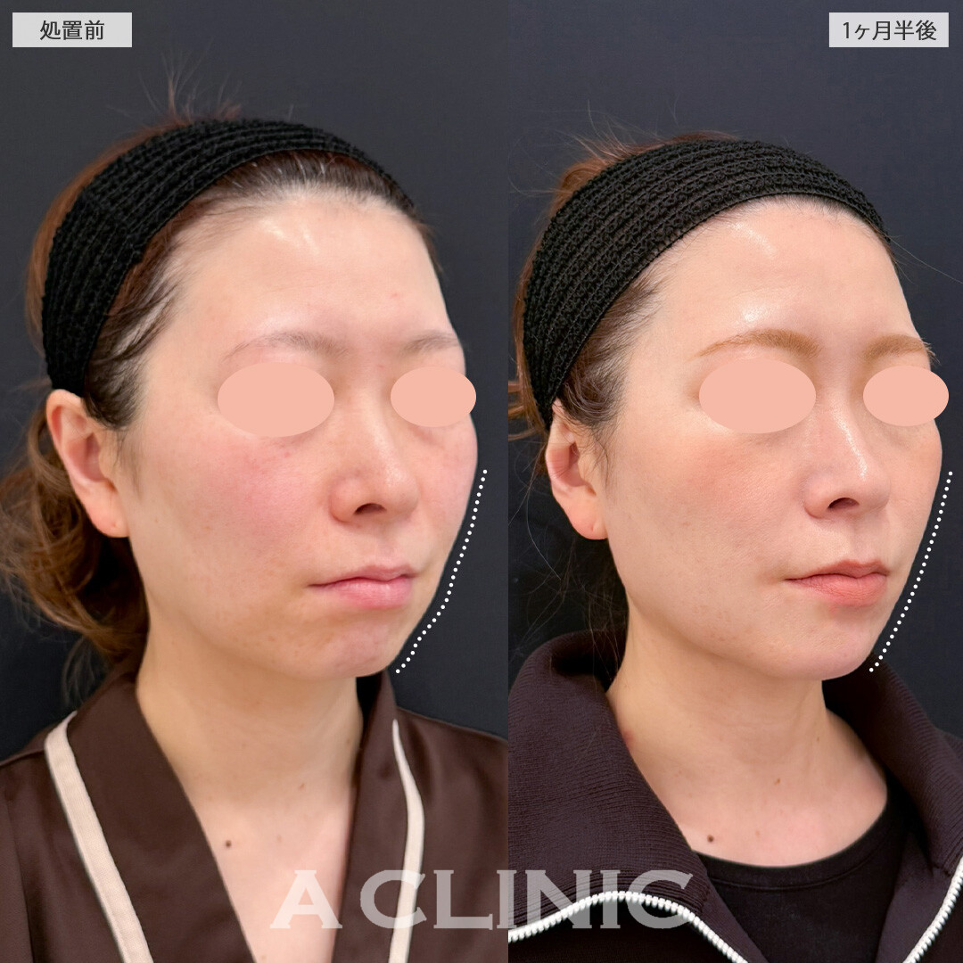 1day小顔脂肪吸引で要らない脂肪がなくなりアゴ下もかなりすっきりしました！こちら処置前と1ヶ月半後の症例です(40代女性)