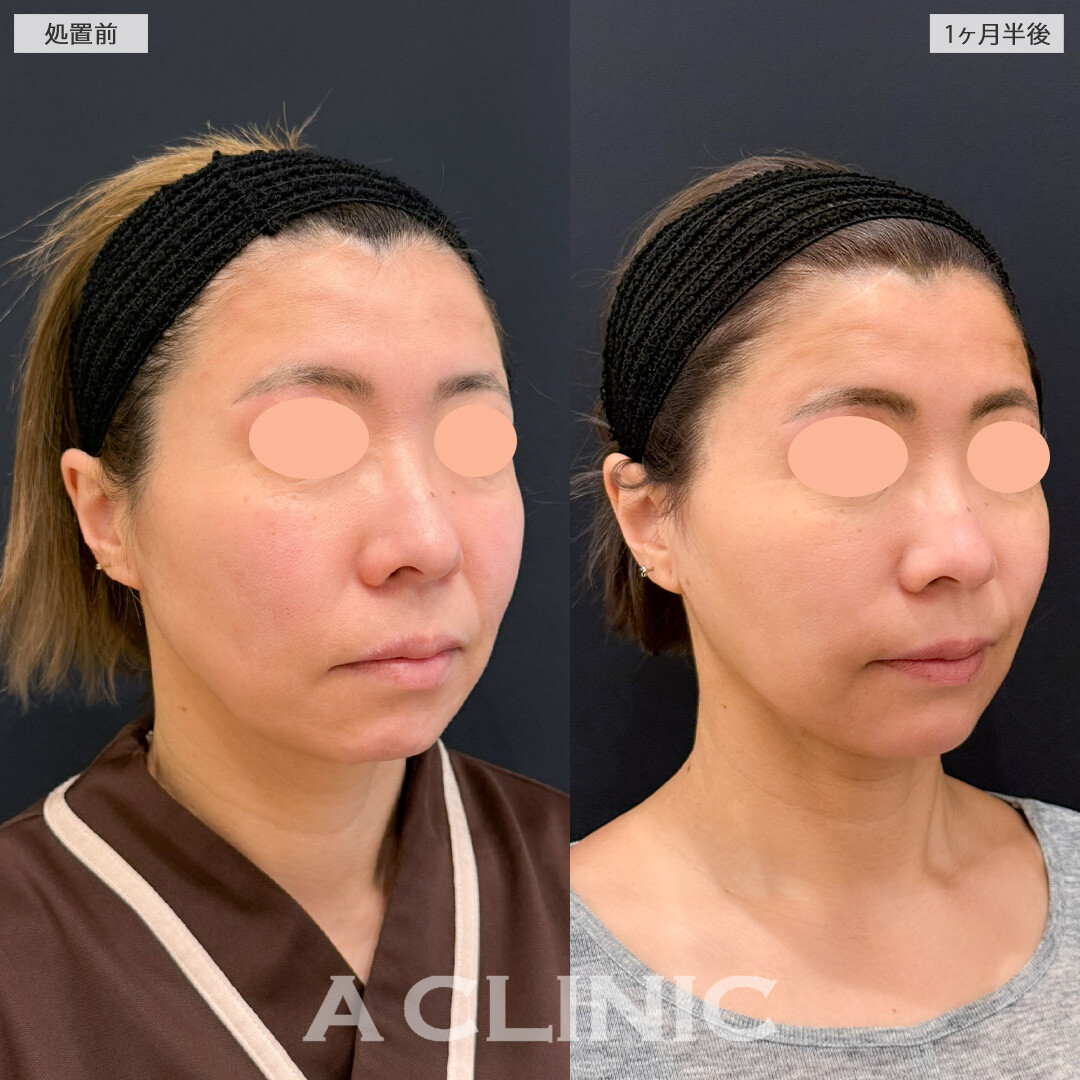 A式ナゾラリフトとバッカルファット除去術で笑った時のボリューム感を抑えられます！こちら処置前と1ヶ月半後の症例です(40代女性)