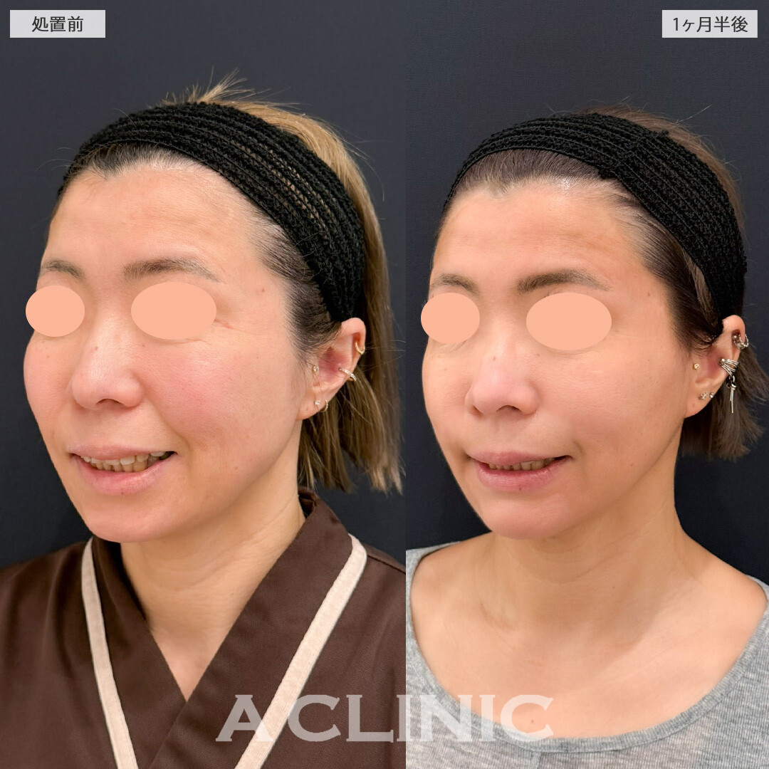 A式ナゾラリフトとバッカルファット除去術で笑った時のボリューム感を抑えられます！こちら処置前と1ヶ月半後の症例です(40代女性)
