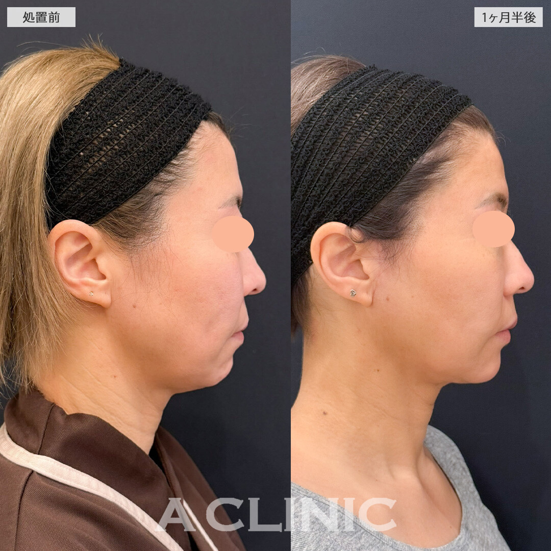 A式ナゾラリフトとバッカルファット除去術で笑った時のボリューム感を抑えられます！こちら処置前と1ヶ月半後の症例です(40代女性)