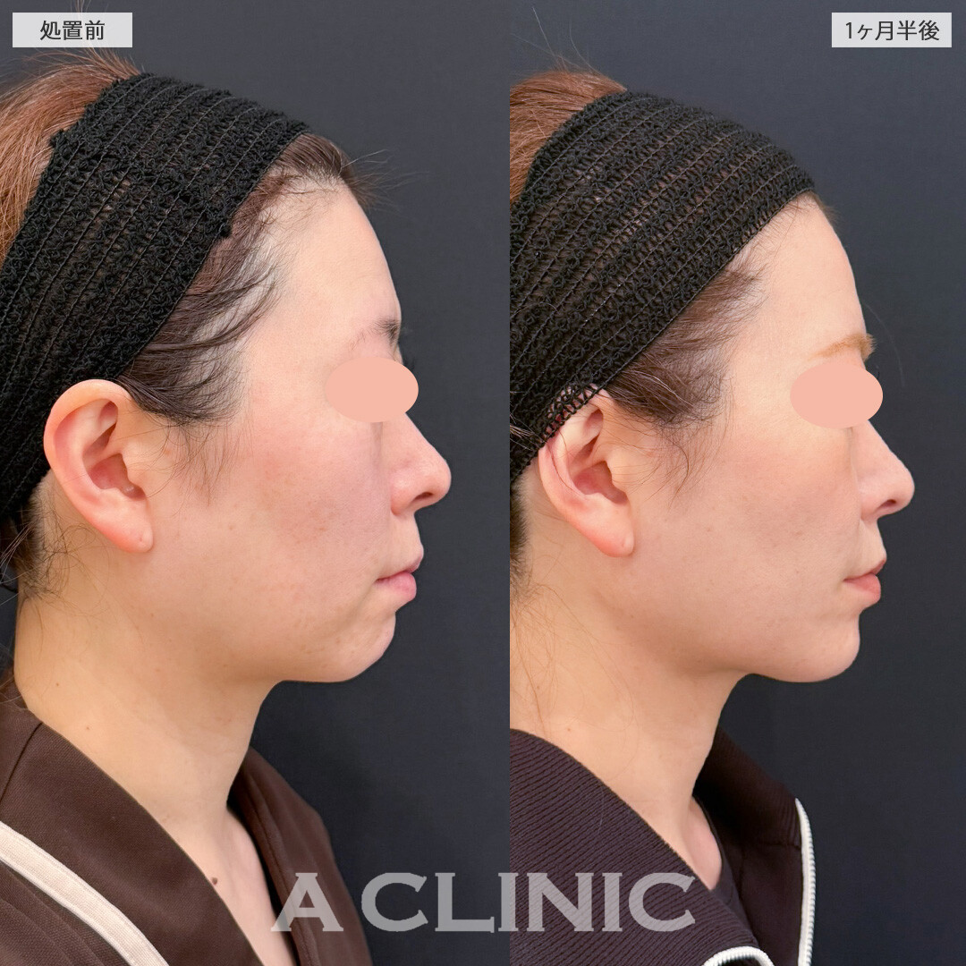 1day小顔脂肪吸引で要らない脂肪がなくなりアゴ下もかなりすっきりしました！こちら処置前と1ヶ月半後の症例です(40代女性)