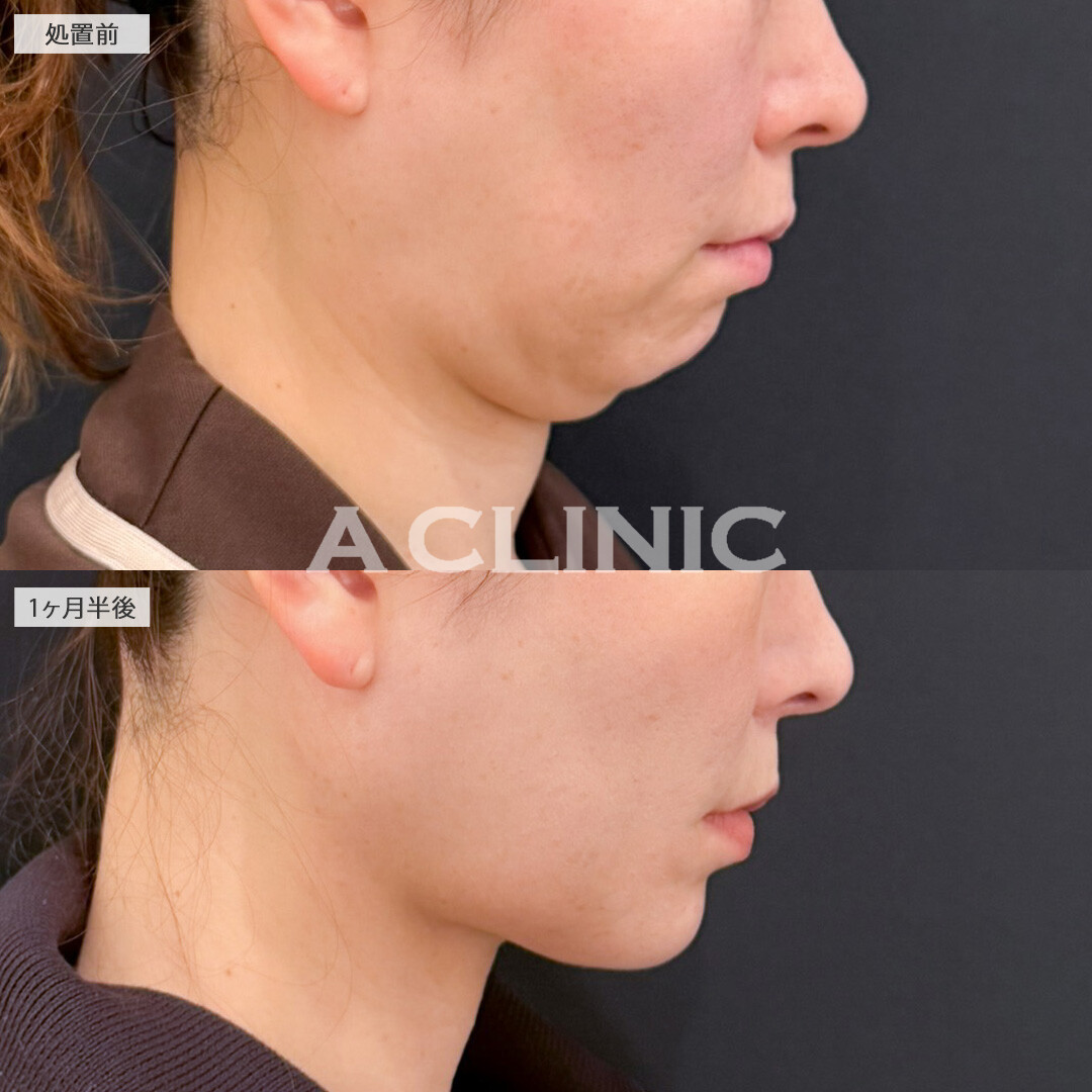 1day小顔脂肪吸引で要らない脂肪がなくなりアゴ下もかなりすっきりしました！こちら処置前と1ヶ月半後の症例です(40代女性)