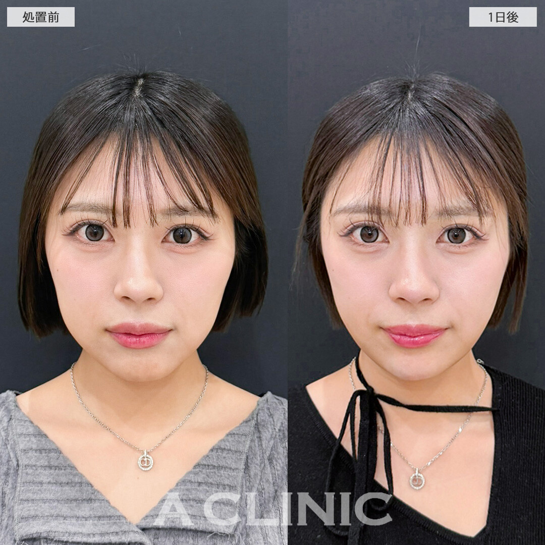 1day小顔脂肪吸引はダウンタイム少なく理想の小顔になれます！こちら処置前と1日後の症例です(20代女性)