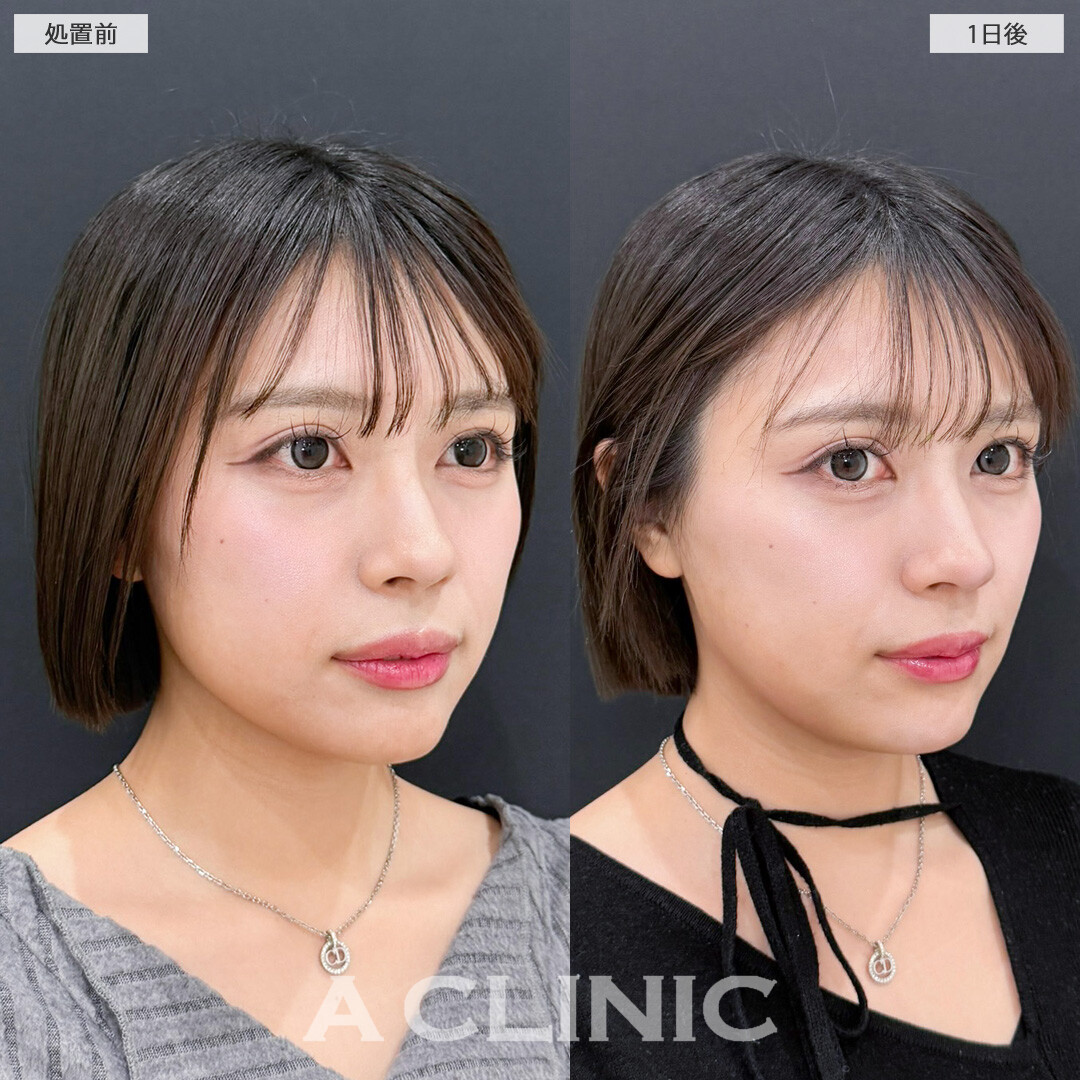 1day小顔脂肪吸引はダウンタイム少なく理想の小顔になれます！こちら処置前と1日後の症例です(20代女性)