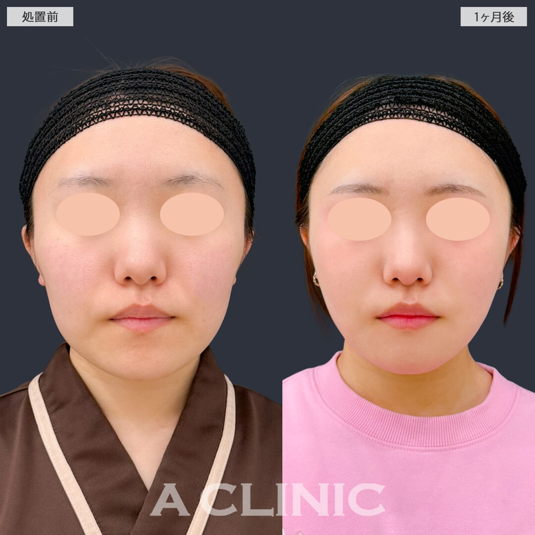 1day小顔脂肪吸引と頬へのヒアルロン酸注入で不要な脂肪を除去しつつ凹みも改善してエッグフェイスに！こちら処置前と1ヶ月後の症例です(20代女性)