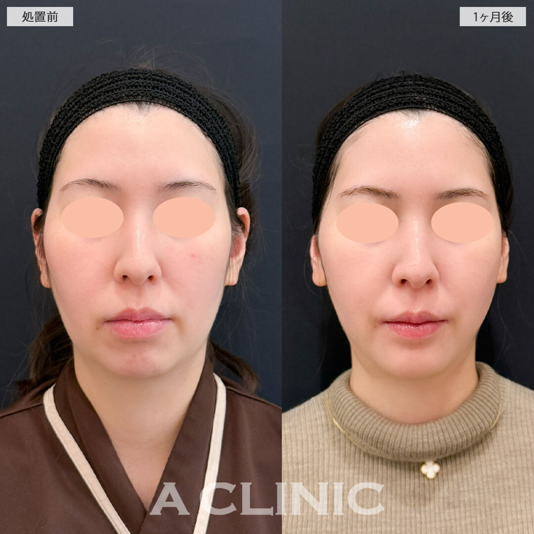 1day小顔脂肪吸引とあごへのヒアルロン酸注入と頬へのヒアルロン酸注入で理想のエッグフェイスに！こちら処置前と1か月後の症例です(30代女性)