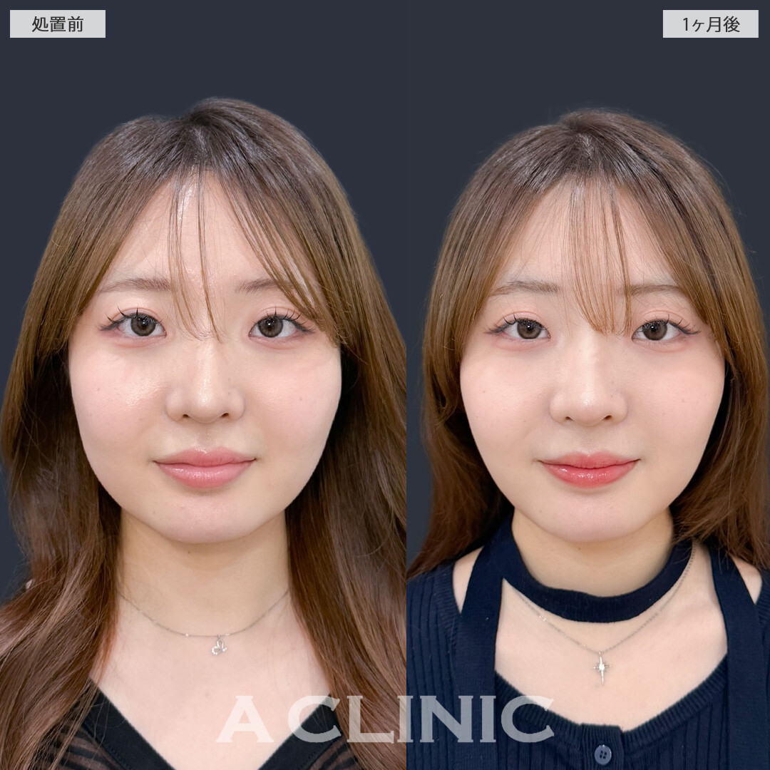 1day小顔脂肪吸引とバッカルファット除去術で不要な脂肪をなくしてナチュラルな小顔に！こちら処置前と1ヶ月後の症例です(20代女性)
