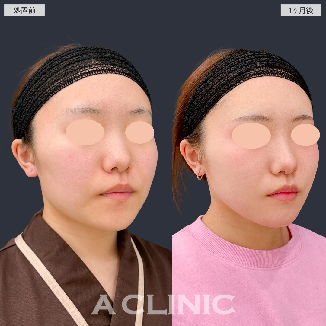 1day小顔脂肪吸引と頬へのヒアルロン酸注入で不要な脂肪を除去しつつ凹みも改善してエッグフェイスに！こちら処置前と1ヶ月後の症例です(20代女性)