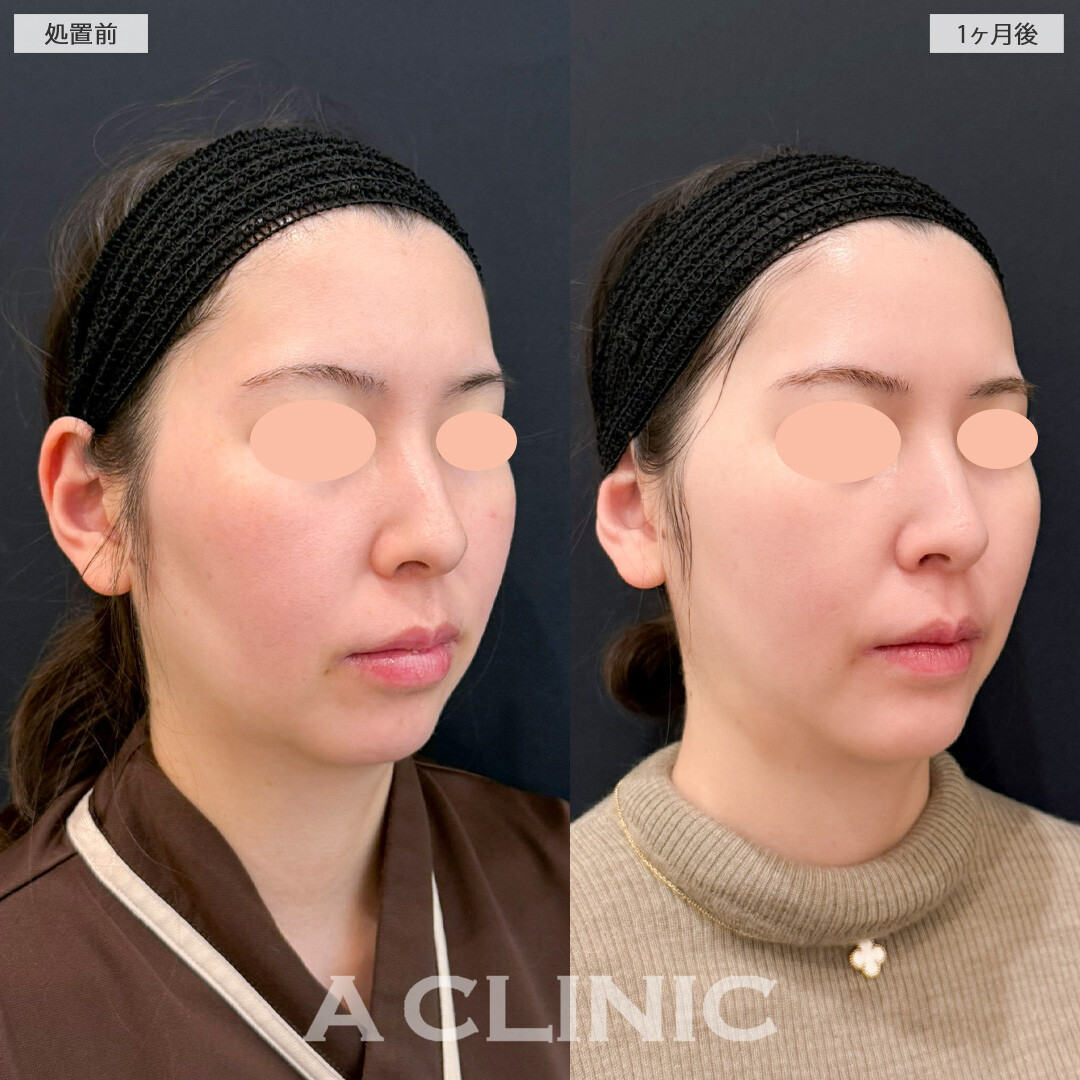 1day小顔脂肪吸引とあごへのヒアルロン酸注入と頬へのヒアルロン酸注入で理想のエッグフェイスに！こちら処置前と1か月後の症例です(30代女性)