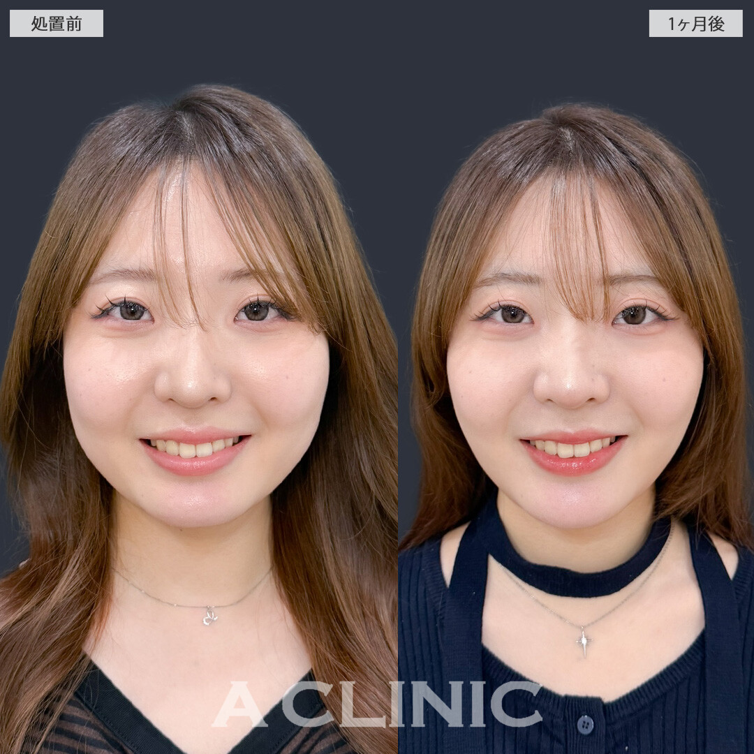 1day小顔脂肪吸引とバッカルファット除去術で不要な脂肪をなくしてナチュラルな小顔に！こちら処置前と1ヶ月後の症例です(20代女性)