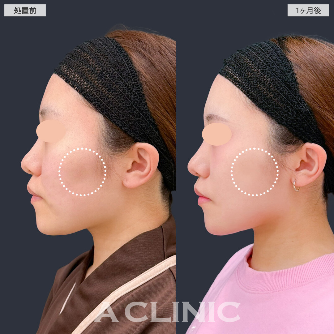 1day小顔脂肪吸引と頬へのヒアルロン酸注入で不要な脂肪を除去しつつ凹みも改善してエッグフェイスに！こちら処置前と1ヶ月後の症例です(20代女性)