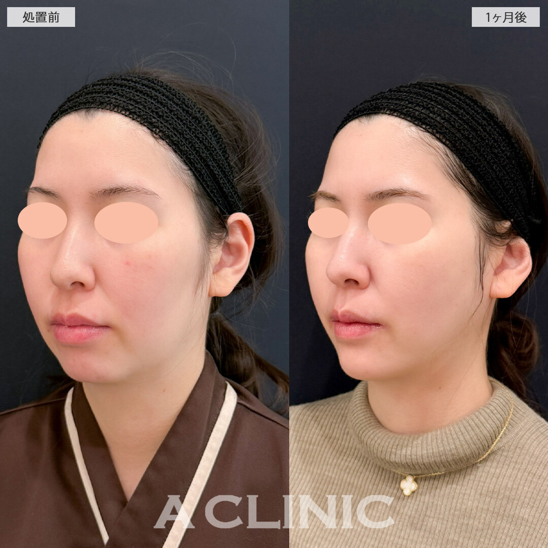 1day小顔脂肪吸引とあごへのヒアルロン酸注入と頬へのヒアルロン酸注入で理想のエッグフェイスに！こちら処置前と1か月後の症例です(30代女性)
