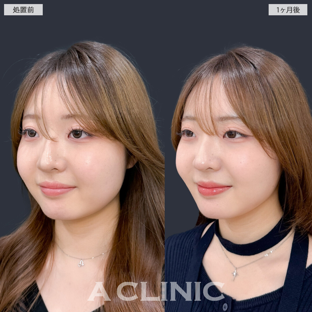 1day小顔脂肪吸引とバッカルファット除去術で不要な脂肪をなくしてナチュラルな小顔に！こちら処置前と1ヶ月後の症例です(20代女性)