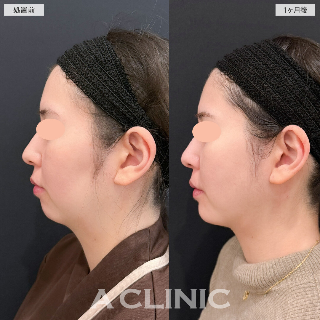 1day小顔脂肪吸引とあごへのヒアルロン酸注入と頬へのヒアルロン酸注入で理想のエッグフェイスに！こちら処置前と1か月後の症例です(30代女性)