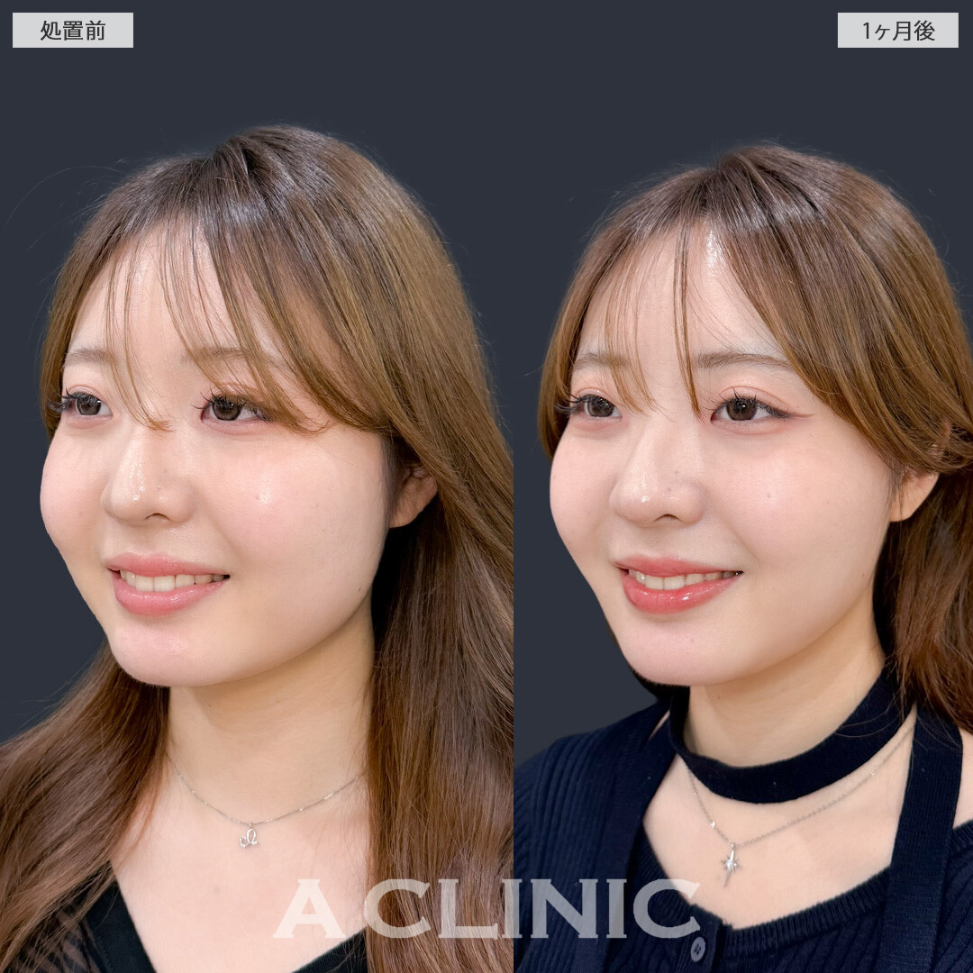 1day小顔脂肪吸引とバッカルファット除去術で不要な脂肪をなくしてナチュラルな小顔に！こちら処置前と1ヶ月後の症例です(20代女性)