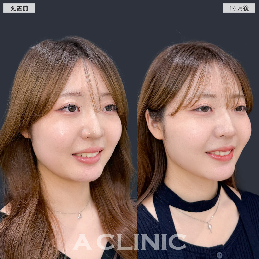 1day小顔脂肪吸引とバッカルファット除去術で不要な脂肪をなくしてナチュラルな小顔に！こちら処置前と1ヶ月後の症例です(20代女性)
